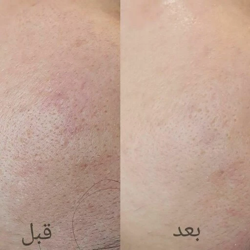 دستگاه میکرودرم خانگی